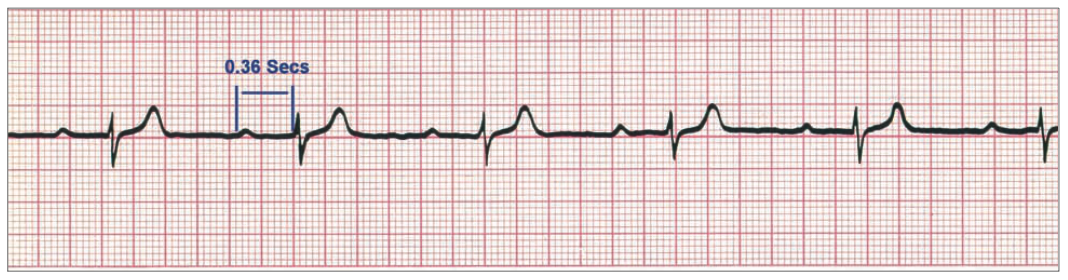 1stdegreeheartblock.png