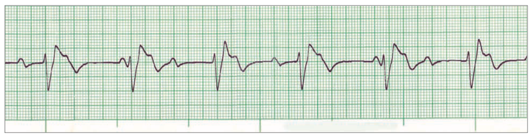 3rddegreeheartblock.png