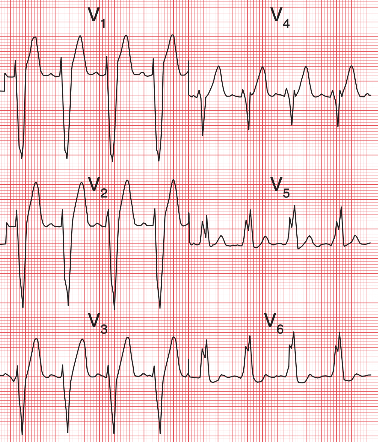 lbbb.png
