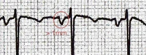 p-biphasic.jpg