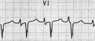 p-pulmonale.jpg
