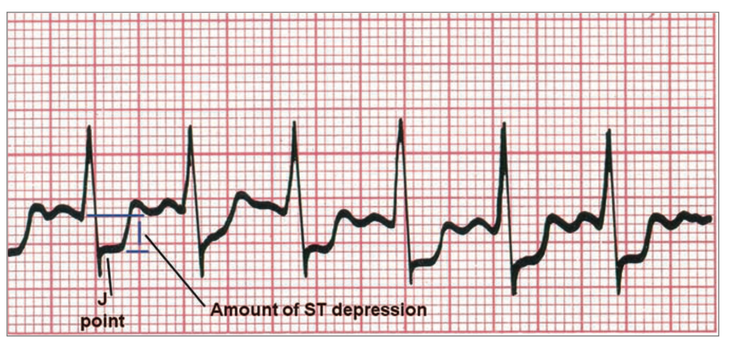 stdepression.png